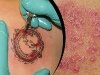 composite_photo_of_tattoo_and_psoriasis